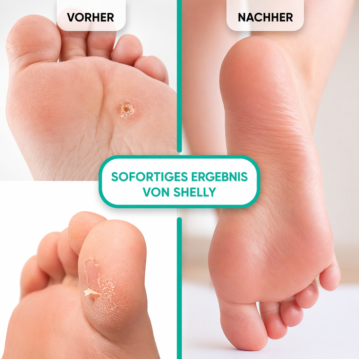 Shelly Keratolytisches Gel für gezielte Anwendung „Soft Blade“, 100 ml - Ivaka Store