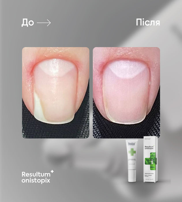 Resultum Onistopix Oil, 8-15 ml