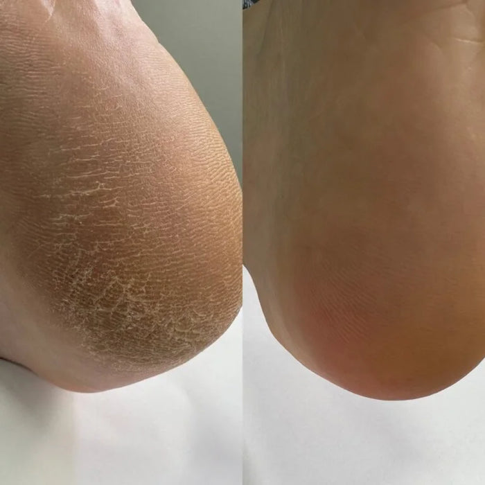 NAILSOFTHEDAY Podology+ Keratolytic für Füße, 100  ml - Ivaka Store