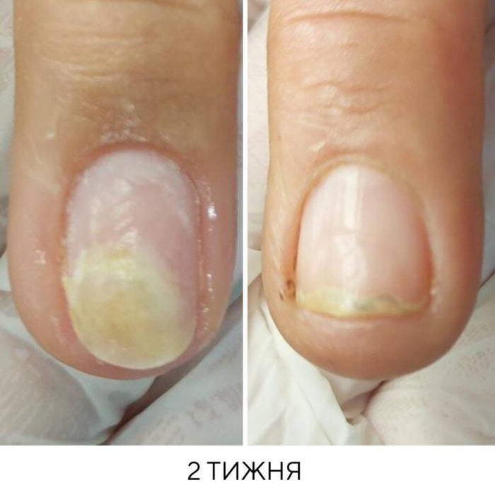 NAILSOFTHEDAY Onistop, ONYCHOLYSE Molecular Oil, 15 m